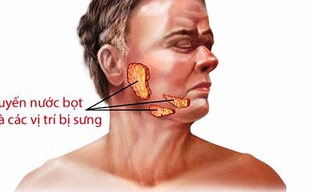 Bệnh quai bị và những điều cần biết benh quai bi va nhung dieu can biet