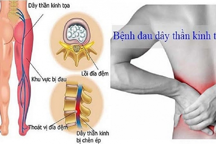 Bài tập dành cho người đau thần kinh tọa bai tap danh cho nguoi dau than kinh toa