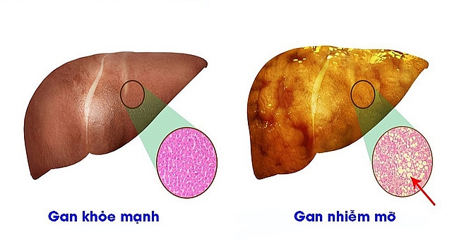 Cải thiện tình trạng gan nhiễm mỡ bằng thực phẩm? cai thien tinh trang gan nhiem mo bang thuc pham