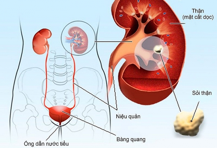Bấm huyệt giúp hỗ trợ điều trị bệnh sỏi thận bam huyet giup ho tro dieu tri benh soi than