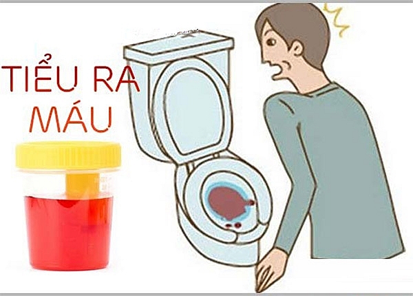 Tiểu máu là gì, nguyên nhân triệu chứng và cách chữa trị? chua tieu mau bang phuong phap bam huyet
