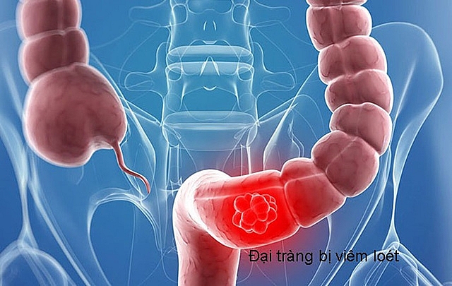 Điều trị bệnh viêm đại tràng bằng phương pháp bấm huyệt dieu tri benh viem dai trang bang phuong phap bam huyet