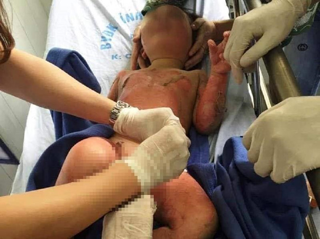 vu 3 tre mam non bi bong suc khoe tien luong rat xau