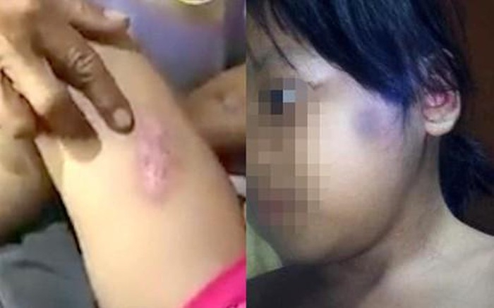 Bị cha dượng bạo hành, bé gái 6 tuổi chịu thương tật 51% bi cha duong bao hanh be gai 6 tuoi chiu thuong tat 51