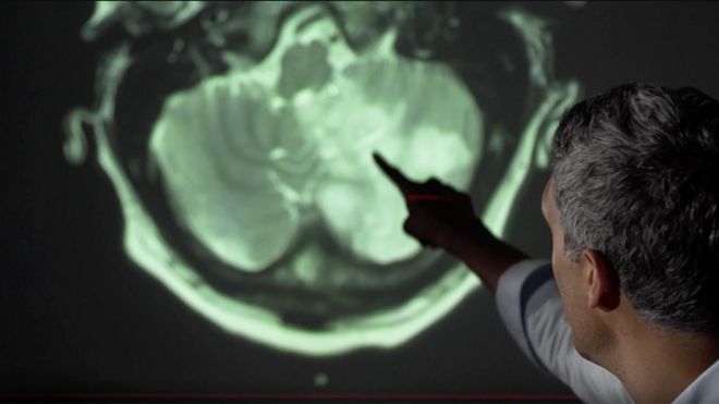 neurologist Arvind Chandratheva points out brain damage on a scan. Photo: BBC 3954113125955 6247092e fd21 44a3 b65d b4e97a833b7e