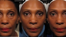 Facial exercises may make you look 3 years younger: Study